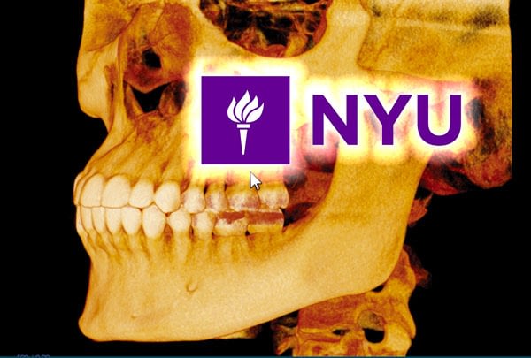 NYU – Predicibilità dei piani di trattamento in implantologia tramite Chirurgia guidata su base modello